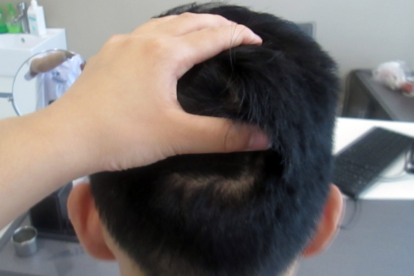 脂溢性脫發(fā)