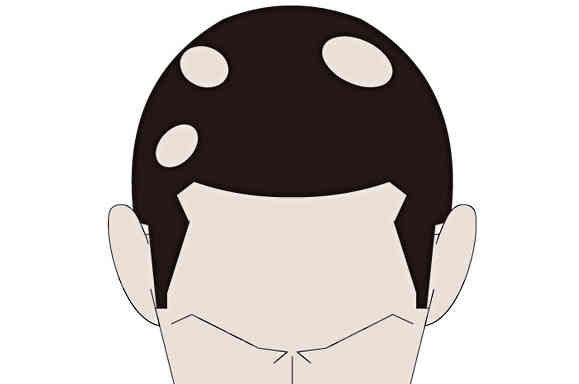 斑禿多久能長(zhǎng)出頭發(fā)