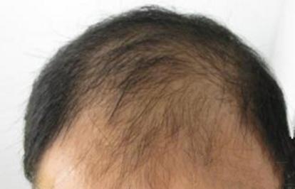 脂溢性脫發(fā)