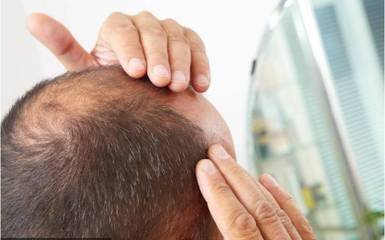 脂溢性脫發(fā)