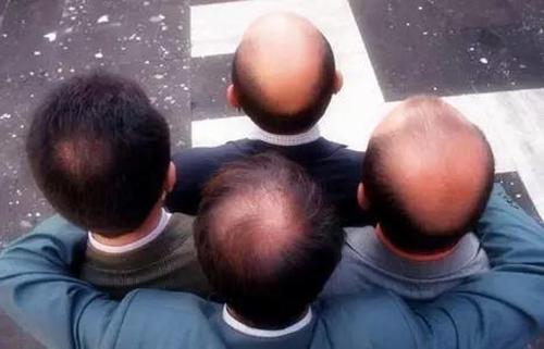 脂溢性脫發(fā)--男女有別？