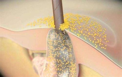 為什么頭皮出油很多