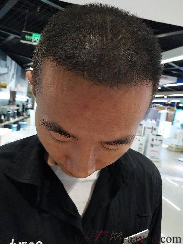 我在上海大麥微針植發(fā)后，6個(gè)月的效果經(jīng)歷