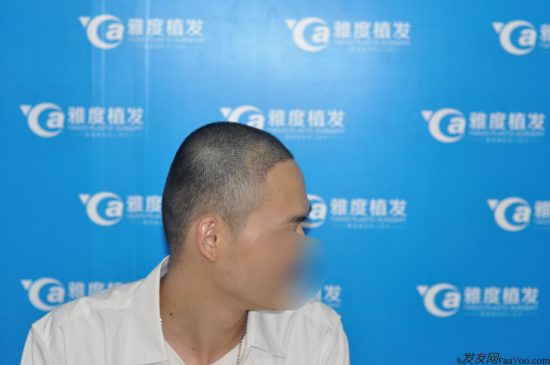 感謝廣州植發(fā)好醫(yī)生，發(fā)際線調(diào)整移植1700單位