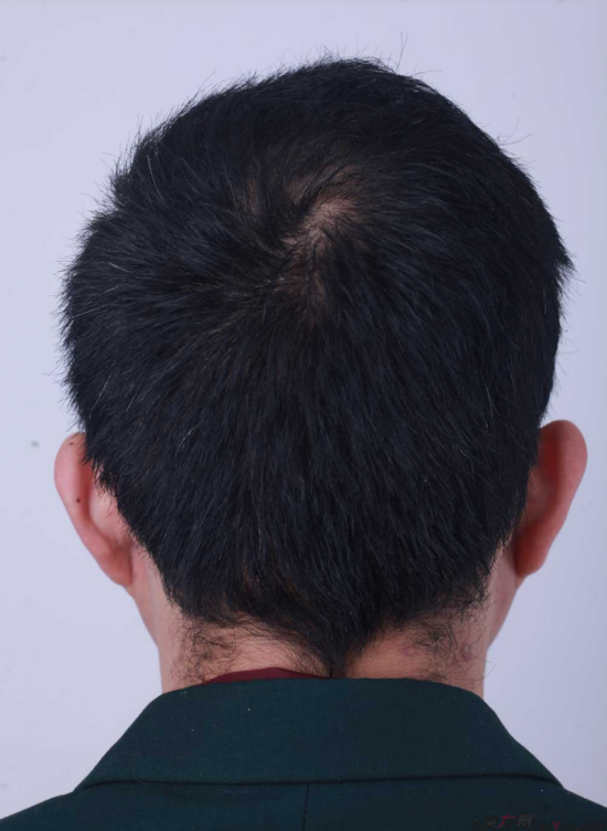 濟(jì)南植發(fā)案例3500單位效果完美，來看我的植發(fā)日記