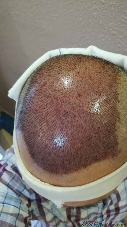 植發(fā)3000單位案例，脫發(fā)5,6年，關(guān)注植發(fā)2年。終于做了