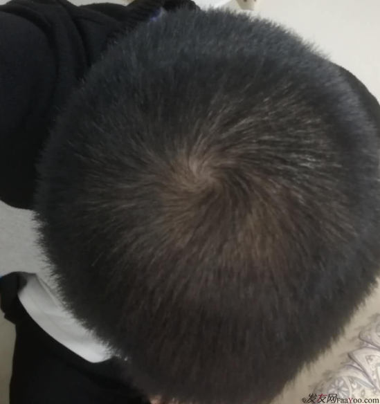 植發(fā)3000單位案例，脫發(fā)5,6年，關(guān)注植發(fā)2年。終于做了