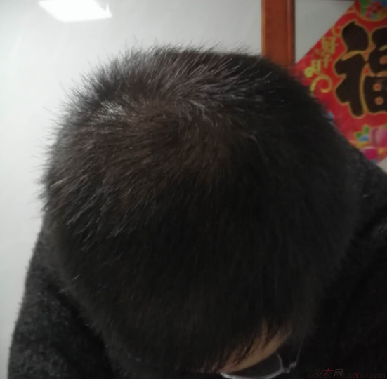 植發(fā)3000單位案例，脫發(fā)5,6年，關(guān)注植發(fā)2年。終于做了