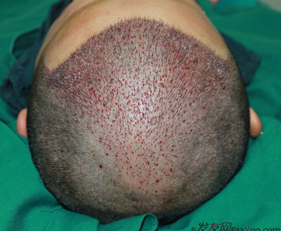 西安大麥微針2800單位慢慢看我蛻變