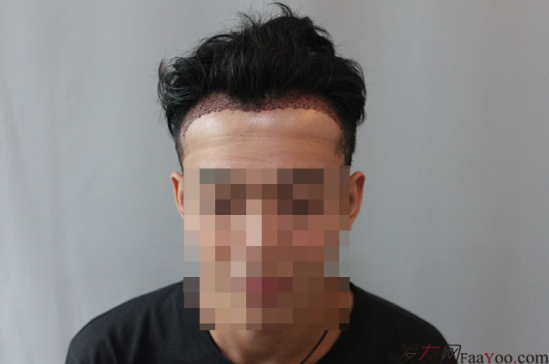 天津新發(fā)現(xiàn)植發(fā)1500單位，組團5折植發(fā)好醫(yī)生活動