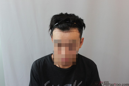 天津新發(fā)現(xiàn)植發(fā)1500單位，組團5折植發(fā)好醫(yī)生活動