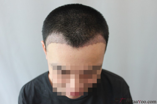 天津新發(fā)現(xiàn)植發(fā)1500單位，組團5折植發(fā)好醫(yī)生活動