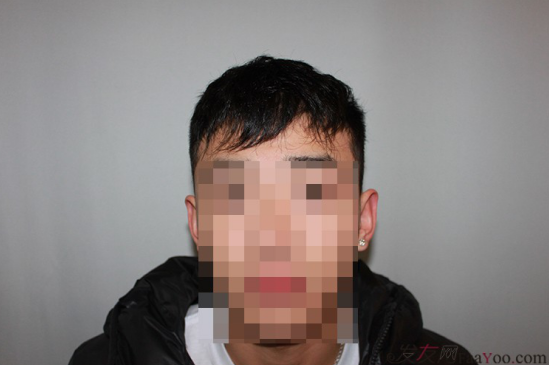 天津新發(fā)現(xiàn)植發(fā)1500單位，組團5折植發(fā)好醫(yī)生活動