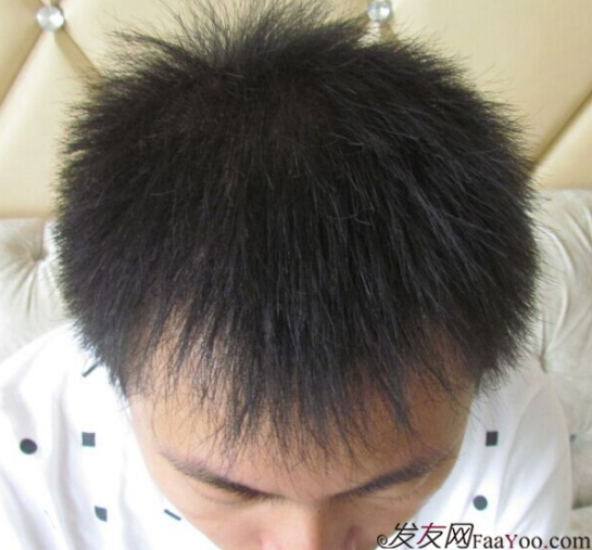 我在南昌大麥微針，上演重返20歲