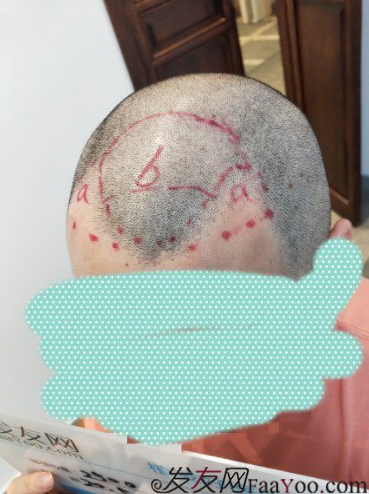 植發(fā)好醫(yī)生：沈陽牛大夫植發(fā)讓我做了一直想做的事情