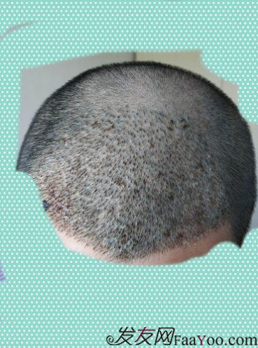 植發(fā)好醫(yī)生：沈陽牛大夫植發(fā)讓我做了一直想做的事情