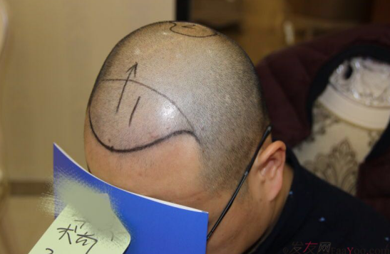 大麥微針植發(fā)案例（原科發(fā)源）——告別地中海，還原年輕態(tài)