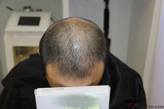 大麥微針植發(fā)案例（原科發(fā)源）——告別地中海，還原年輕態(tài)