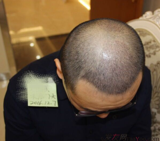 大麥微針植發(fā)案例（原科發(fā)源）——告別地中海，還原年輕態(tài)