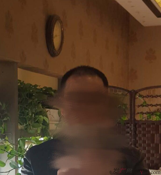 大麥微針植發(fā)案例（原科發(fā)源）——告別地中海，還原年輕態(tài)