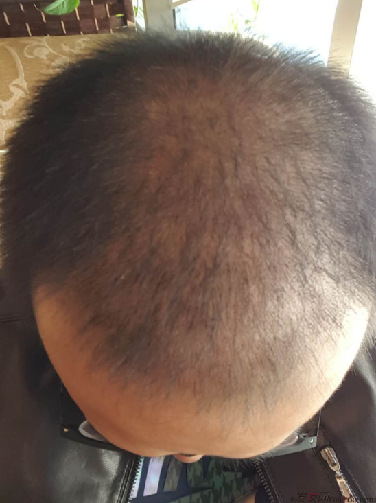 大麥微針植發(fā)案例（原科發(fā)源）——告別地中海，還原年輕態(tài)