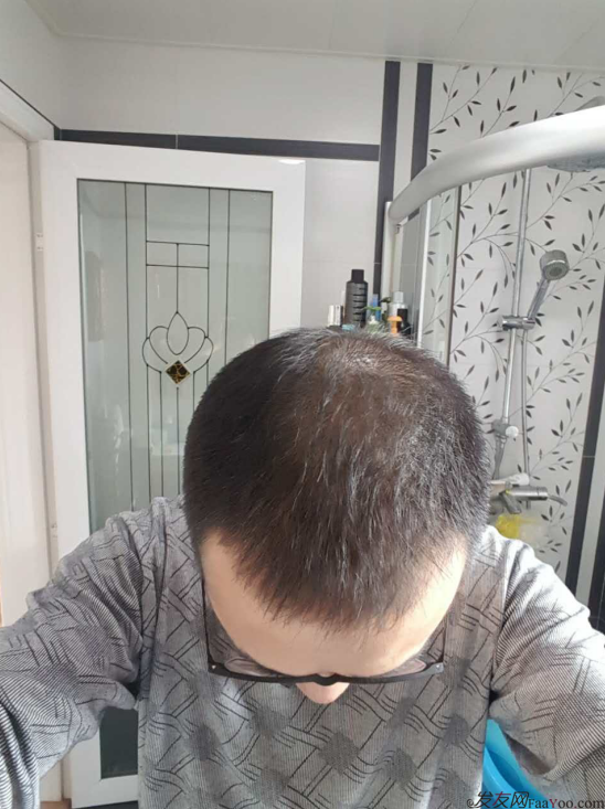 大麥微針植發(fā)案例（原科發(fā)源）——告別地中海，還原年輕態(tài)