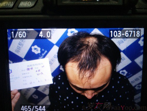 濟(jì)南植發(fā)案例，給你看前后對比圖