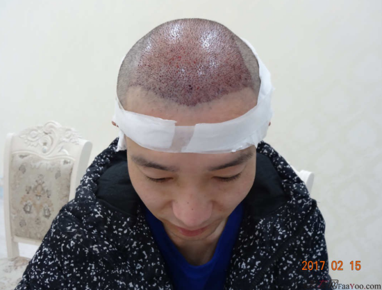 發(fā)案例——六級(jí)脫發(fā)，我覺(jué)得沒(méi)有比我更嚴(yán)重的了