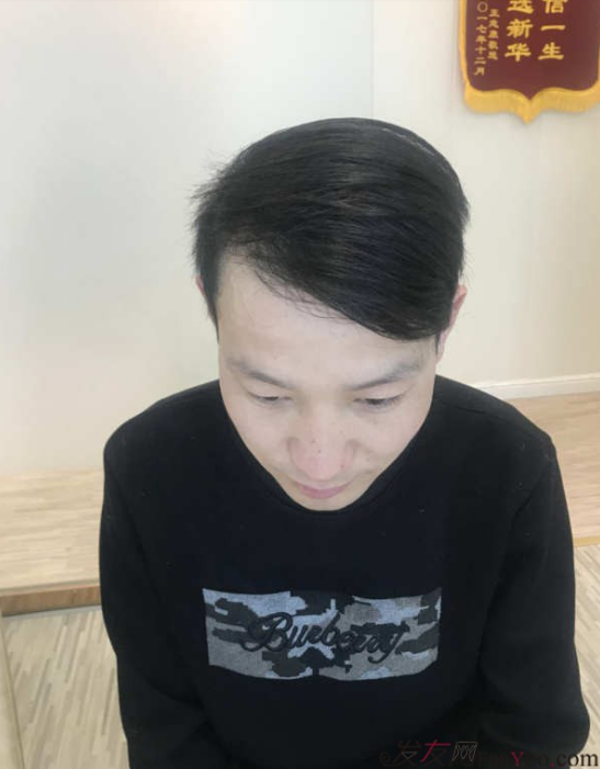 發(fā)案例——六級(jí)脫發(fā)，我覺(jué)得沒(méi)有比我更嚴(yán)重的了