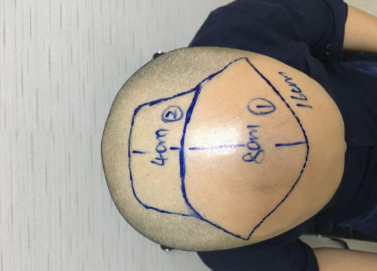 廣州植發(fā)案例，一次大膽的嘗試