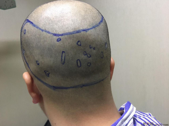 廣州植發(fā)案例，一次大膽的嘗試