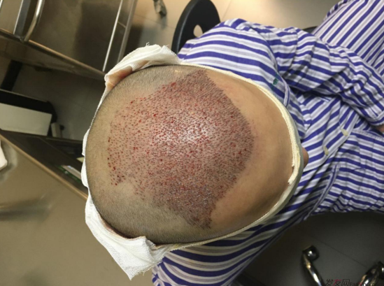 廣州植發(fā)案例，一次大膽的嘗試