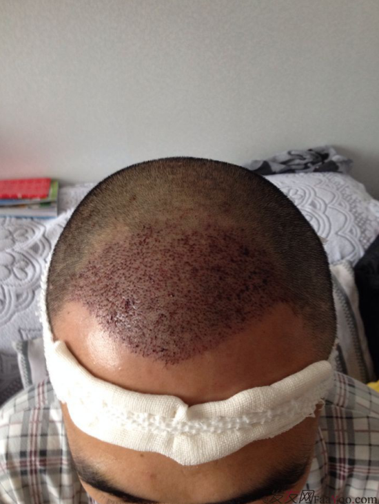 要感謝發(fā)友網(wǎng)我在哈爾濱植發(fā)2500單位