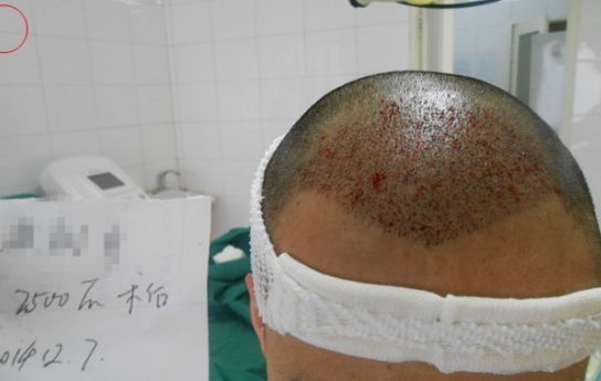 要感謝發(fā)友網(wǎng)我在哈爾濱植發(fā)2500單位