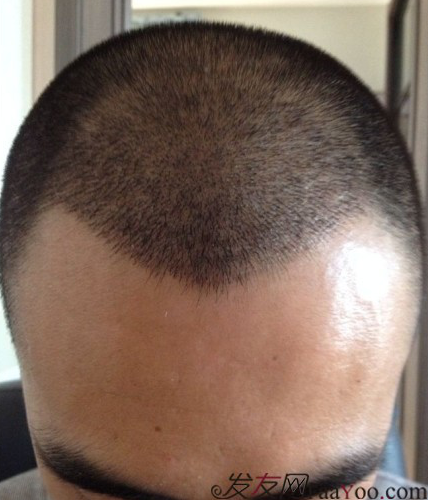 要感謝發(fā)友網(wǎng)我在哈爾濱植發(fā)2500單位