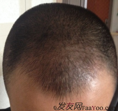 要感謝發(fā)友網(wǎng)我在哈爾濱植發(fā)2500單位