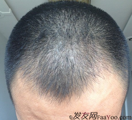 要感謝發(fā)友網(wǎng)我在哈爾濱植發(fā)2500單位