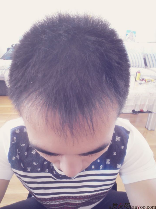 要感謝發(fā)友網(wǎng)我在哈爾濱植發(fā)2500單位