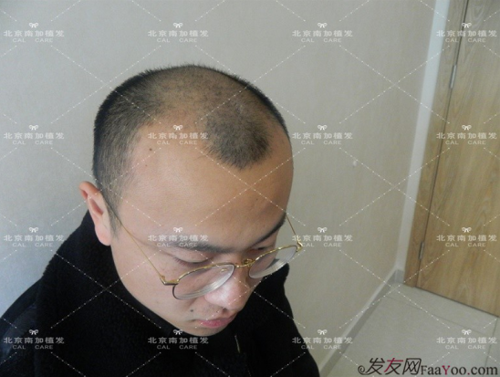 北京南加高醫(yī)生4000單位大面積植發(fā)植發(fā)日記
