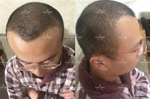 北京南加高醫(yī)生4000單位大面積植發(fā)植發(fā)日記