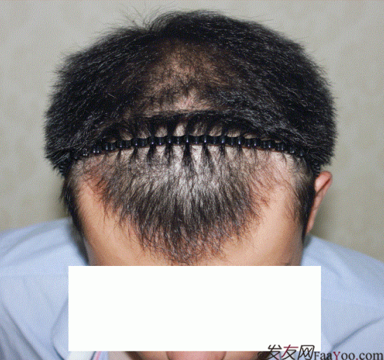 西安大麥微針FUE植發(fā)2100單位，一起等待效果