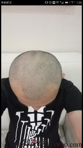 大麥微針植發(fā)案例，植發(fā)過程讓我越來越自信