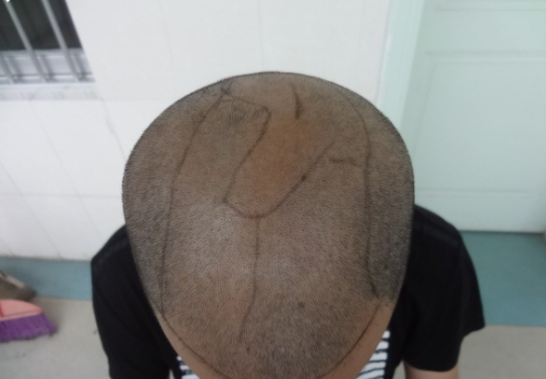 南寧植發(fā)3200單位案例，來(lái)看看我的植發(fā)效果吧