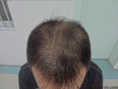 南寧植發(fā)3200單位案例，來(lái)看看我的植發(fā)效果吧