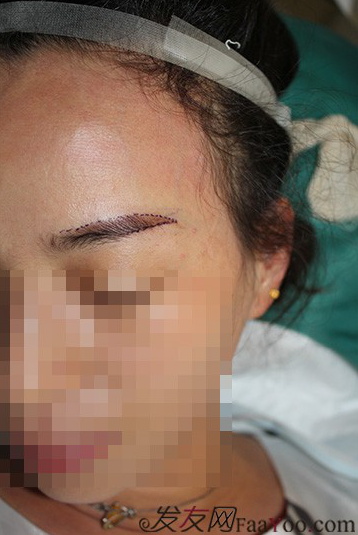 南昌的妹子，種植了眉毛和發(fā)際線，歡迎發(fā)友們圍觀