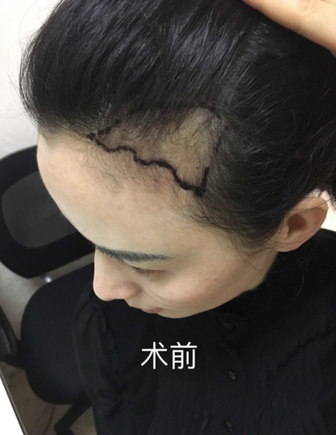 南昌的妹子，種植了眉毛和發(fā)際線，歡迎發(fā)友們圍觀