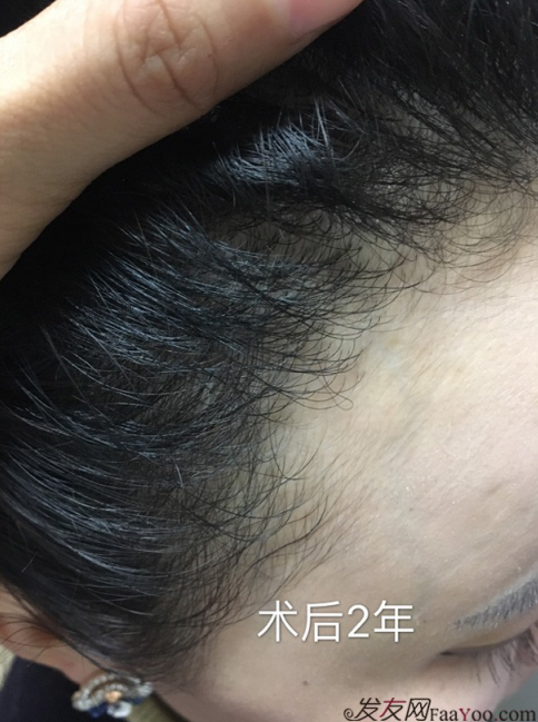 南昌的妹子，種植了眉毛和發(fā)際線，歡迎發(fā)友們圍觀