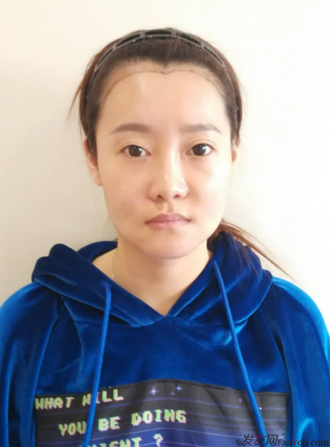 北京南加發(fā)際線調(diào)整案例種植頭發(fā)成功案例