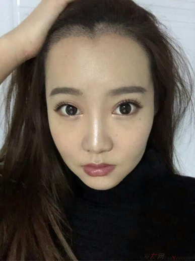 北京南加發(fā)際線調(diào)整案例種植頭發(fā)成功案例