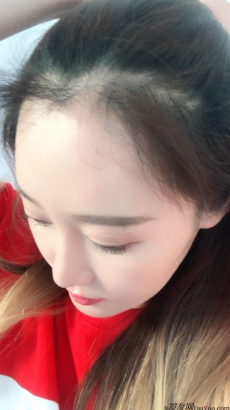 北京南加發(fā)際線調(diào)整案例種植頭發(fā)成功案例